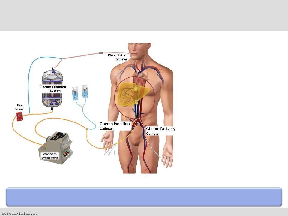 Delcath: arrivata la 74 days letter, via libera alla chemosaturazione?
